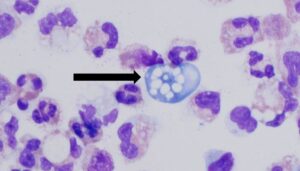 India reports rise in Naegleria deaths