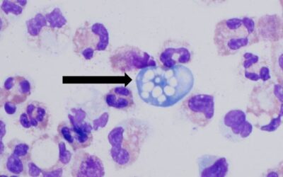 India reports rise in Naegleria deaths