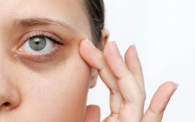 Effective home remedies to lighten dark circles